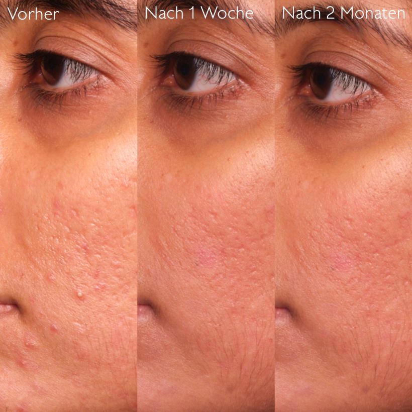 Vinopure - Serum with salicylic acid against impurities