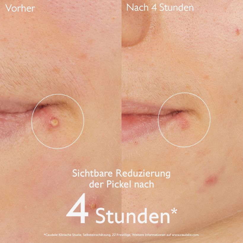 Vinopure - Pickel-Stopp mit Salicylsäure