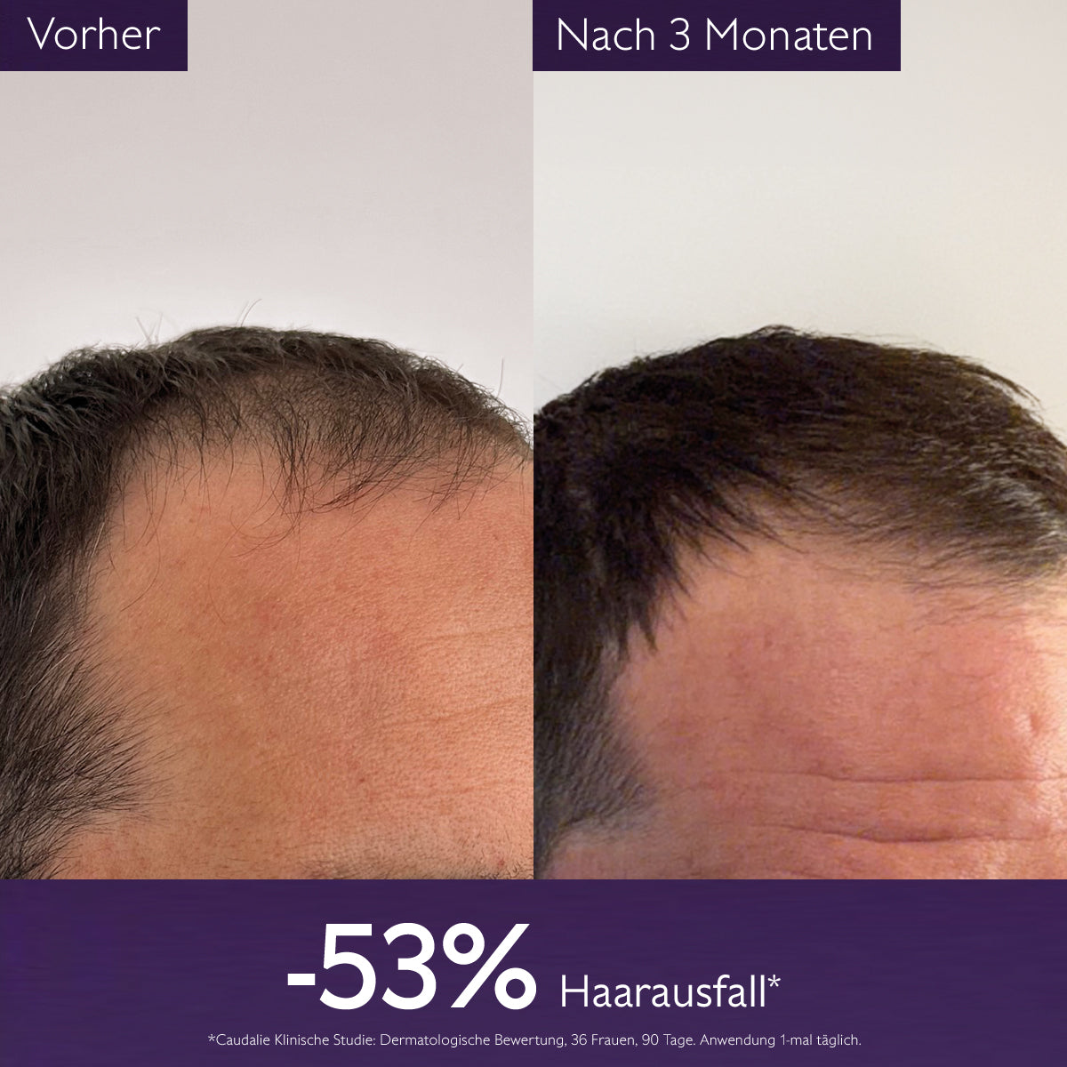 Haarpflege - Anti-Haarausfall-Haarserum